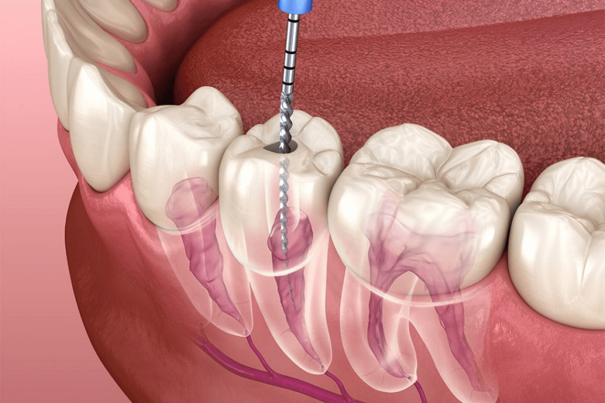 лікування пульпіту